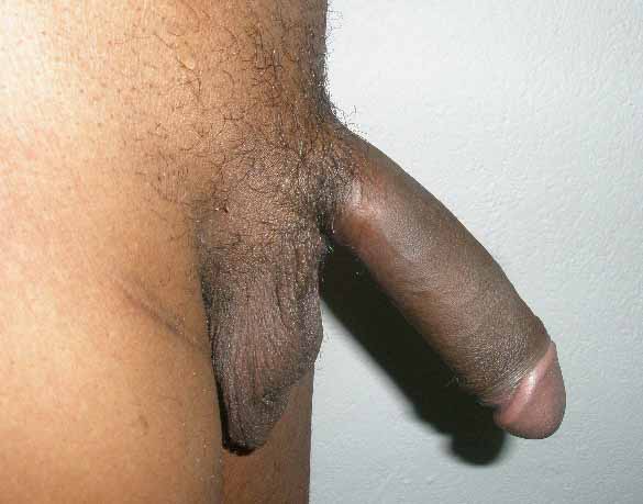 Implanted penis fitted with Shah prosthesis 3.JPG